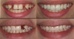 before and after: a perfect smile opens many doors